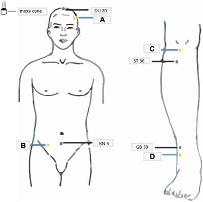 Effects of Moxa Cone Moxibustion Therapy on Cognitive Function and Brain Metabolic Changes in MCI Patients: A Pilot 1H-MRS Study